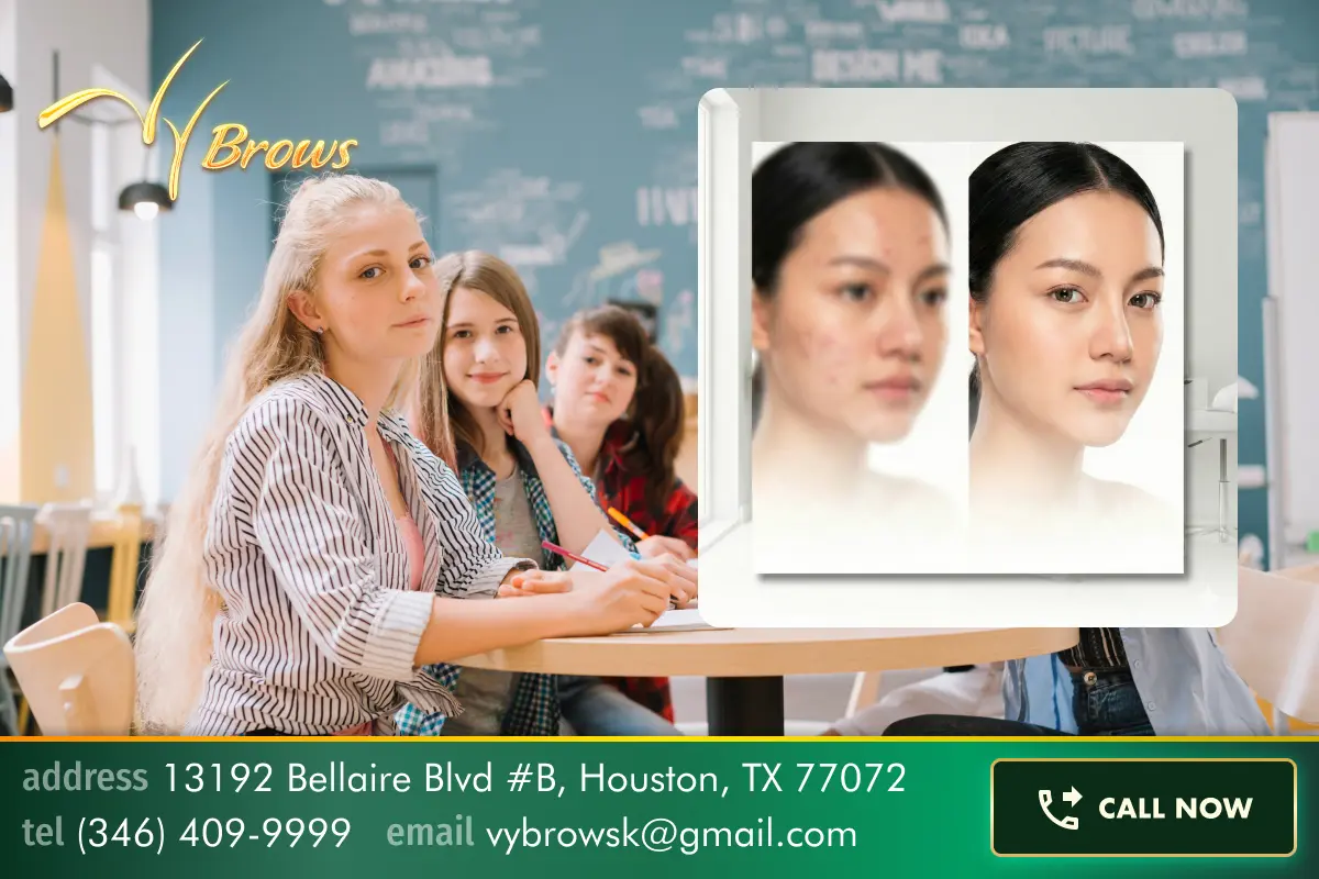 Teen Acne Treatment at VyBrows Beauty — Clear Skin, Restored Confidence